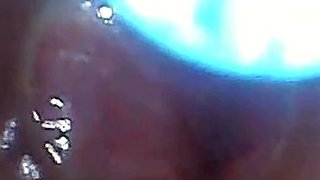Endoscope POV: Test Tube Cock Urethral Insertion